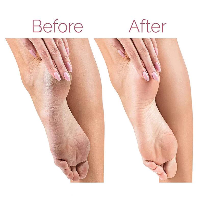 Electric Pedicure Foot File Callus Remover Zerista